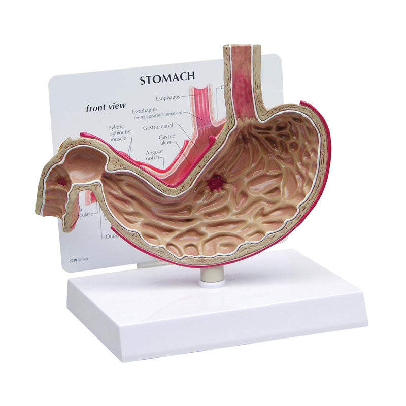 Modelo anatómico del estómago con úlceras.