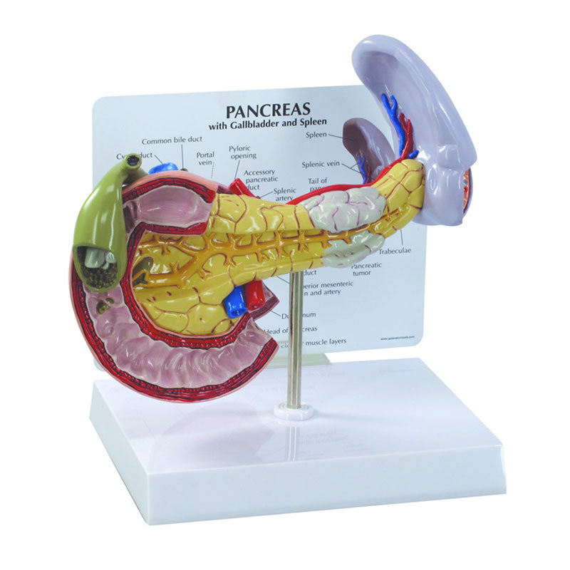 Modelo anatómico del páncreas con cáncer.