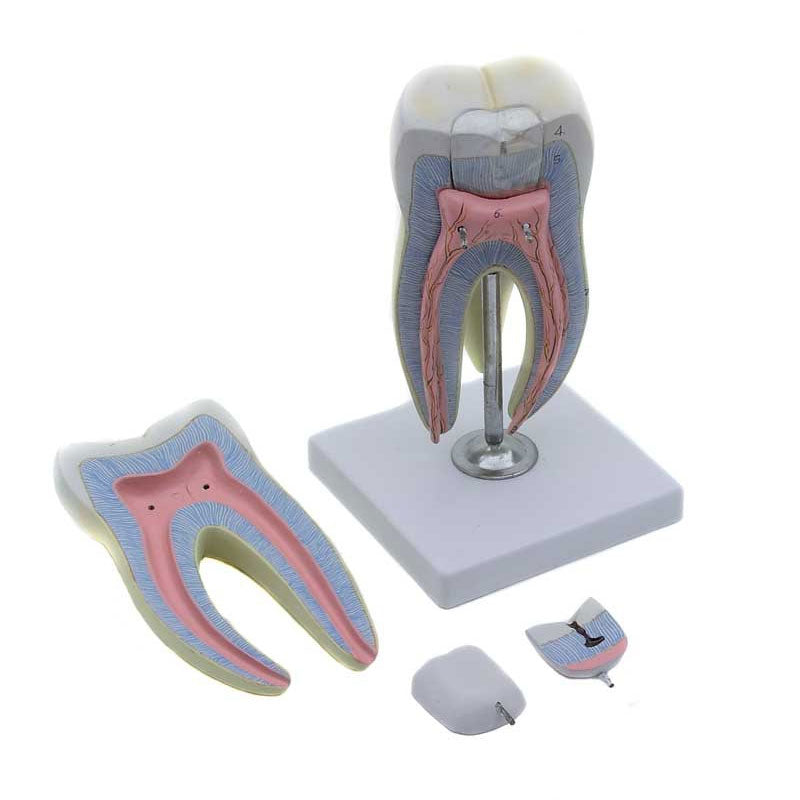 Modelo anatómico de un diente con caries.