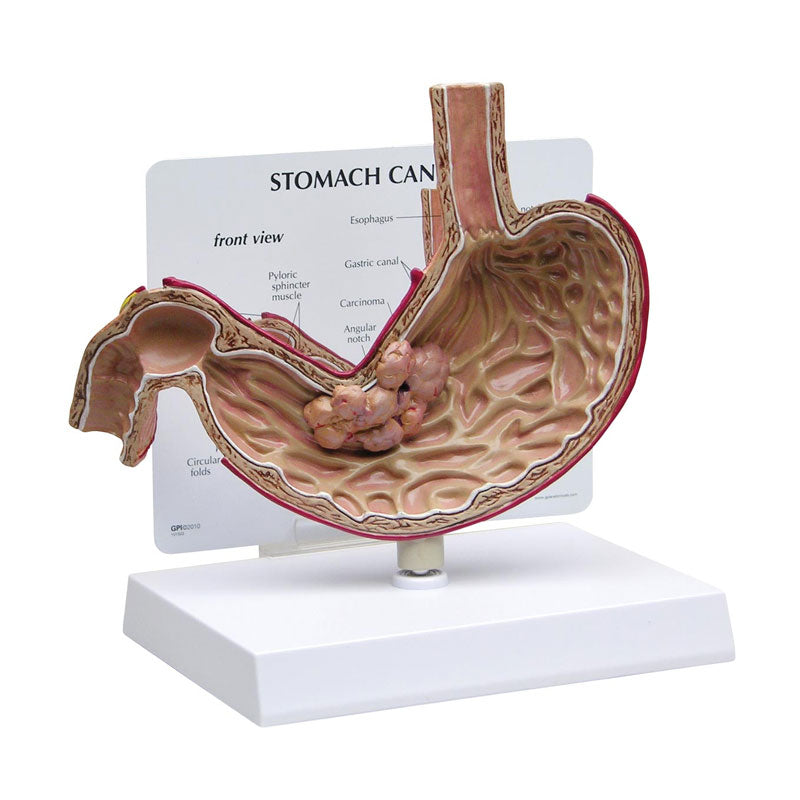 Modelo anatómico de un estómago con cáncer.