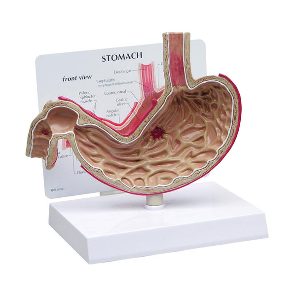 Modelo anatómico do estômago com úlceras