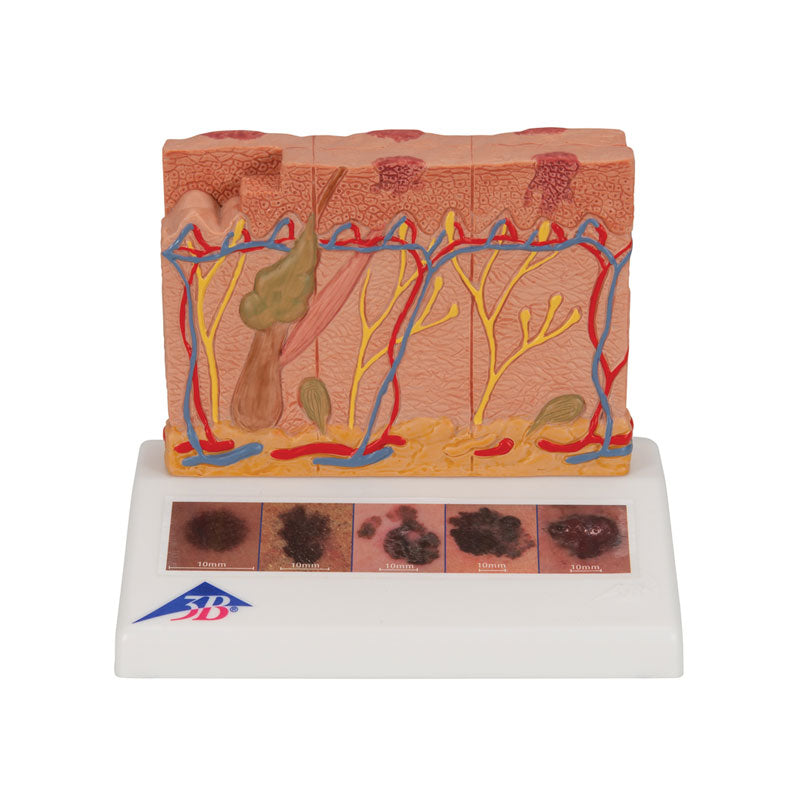 Modelo anatómico del cáncer de piel, 6 estadios.