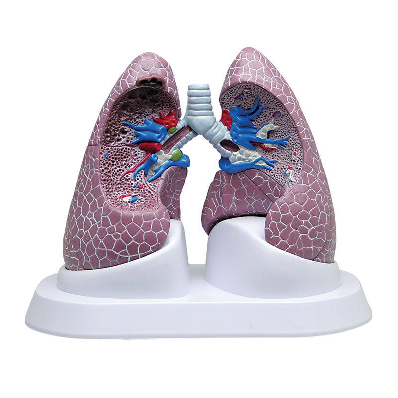 Conjunto de modelos anatómicos de pulmones sanos y pulmones con patologías.