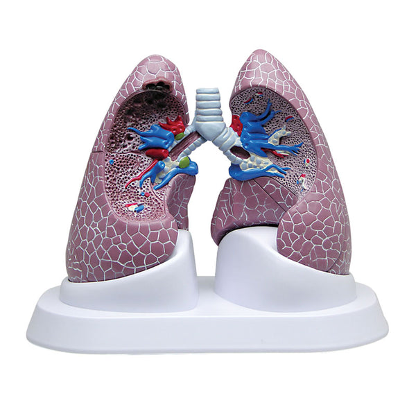 Conjunto de modelo anatómico de pulmões saudáveis e com patologias